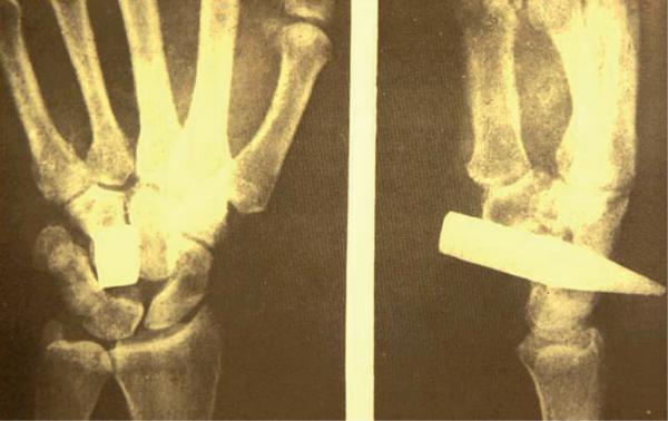 Op de röntgenfoto is te zien dat alleen hier de nagels het gewicht van het hele lichaam kunnen dragen.